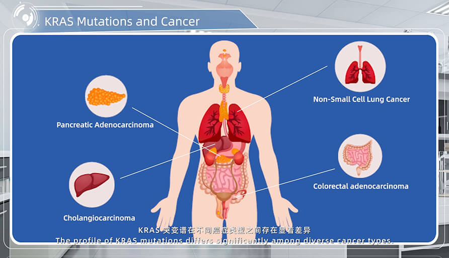 KRAS 突变与癌症的关系